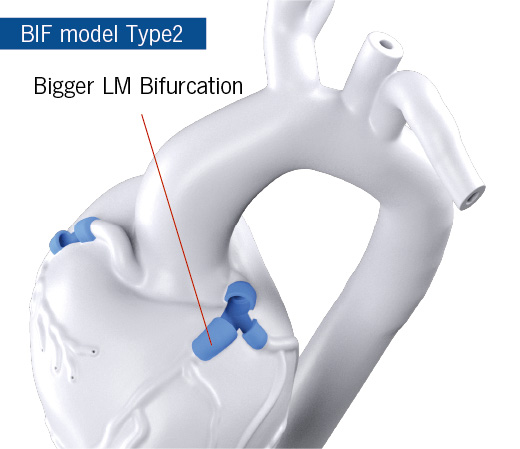 Bigger LM bifurcation