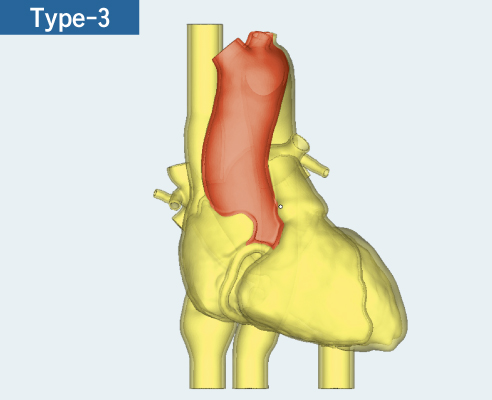 4-chamber design with SVC, IVC and CS