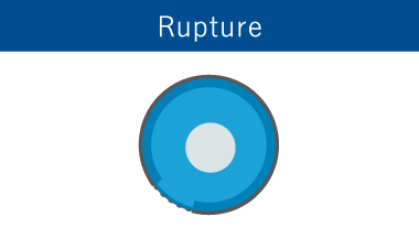 Rupture