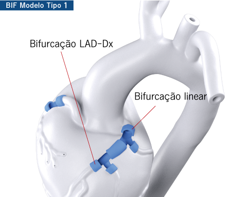 LM bifurcation with LAD-Dx bifurcation