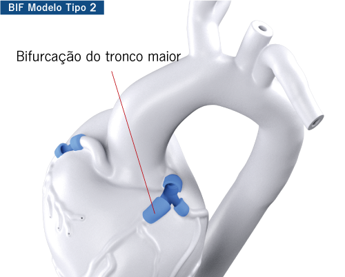 Bigger LM bifurcation